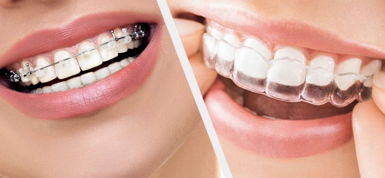 A teenager with braces smiling confidently after orthodontic treatment for improved dental alignment and oral health.